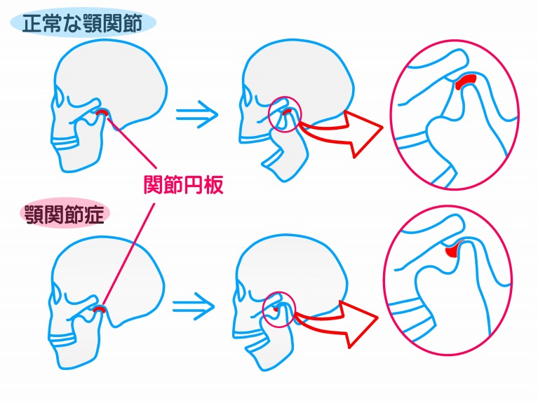 顎関節症に薬やマッサージ、マウスピースなどで改善を図りますついて